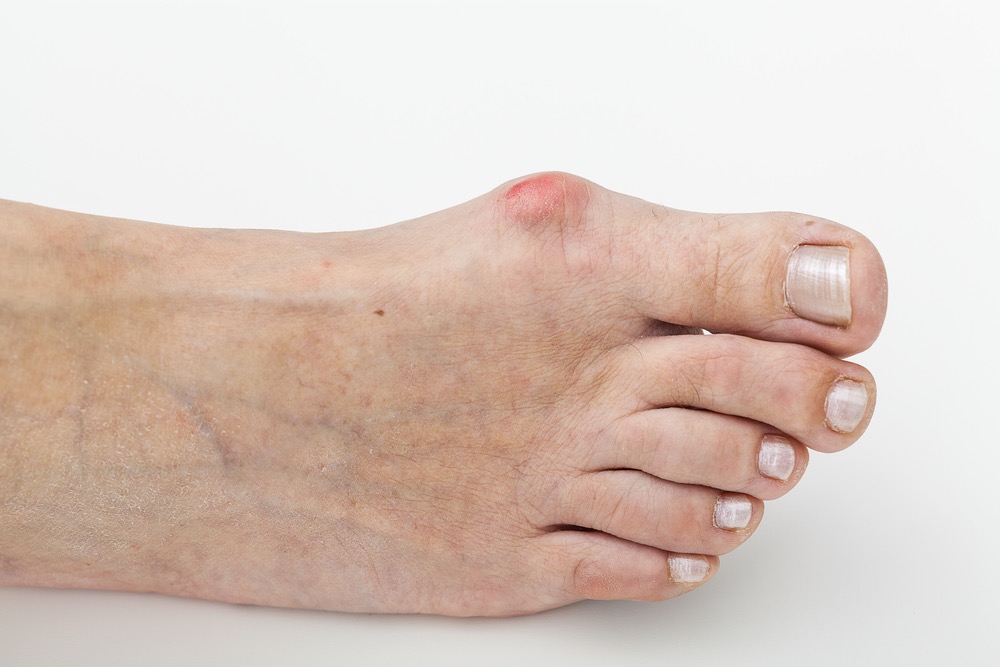 Bunion on the right foot